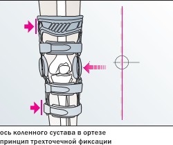 Регулируемый жесткий коленный ортез для лечения остеоартроза M.4s OA - правый вальгус